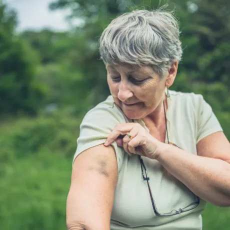 Senior woman with bruise on her arm