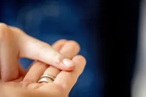 Blog Post: Ward off Warts Naturally