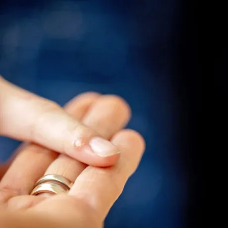 Blog Post: Ward off Warts Naturally