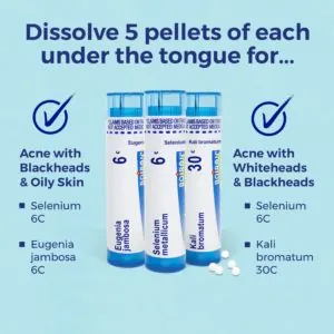 Acne Relief Kit